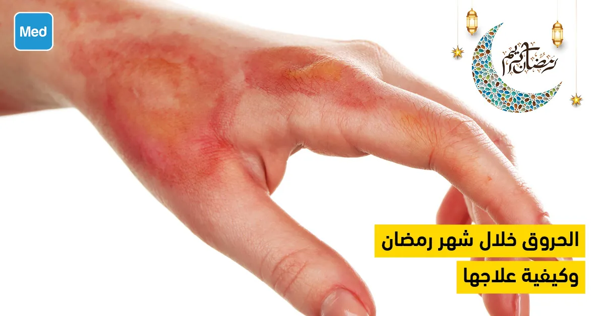 الحروق خلال شهر رمضان وكيفية علاجها